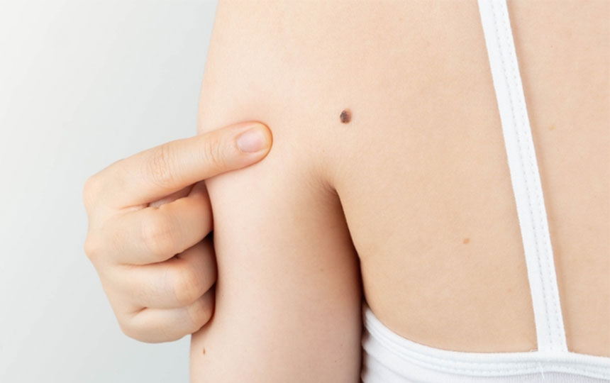 Meaning of moles on body