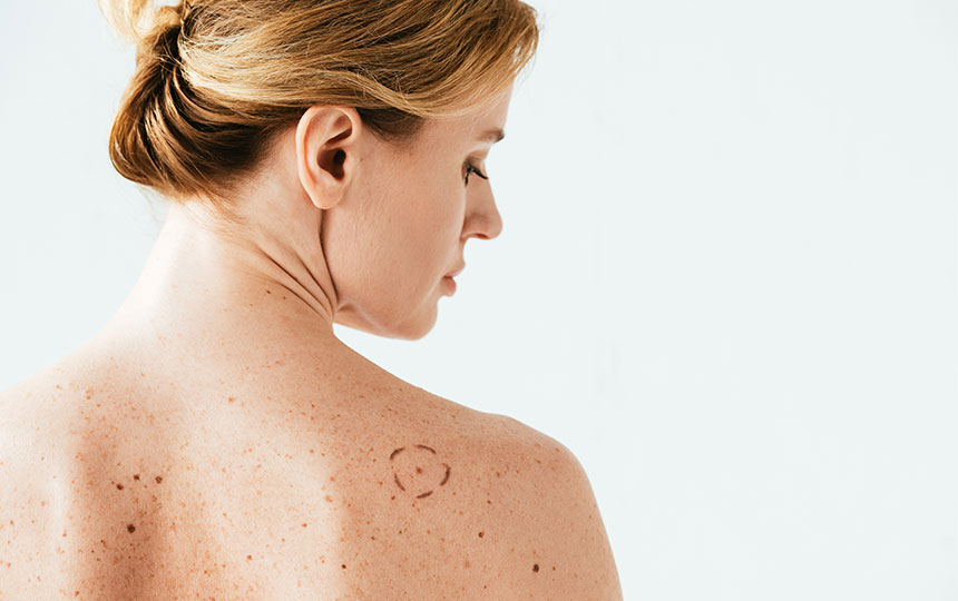 What does mole on back mean?