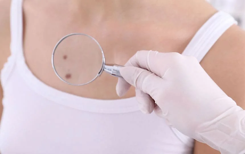 What's the Meaning of mole on chest?