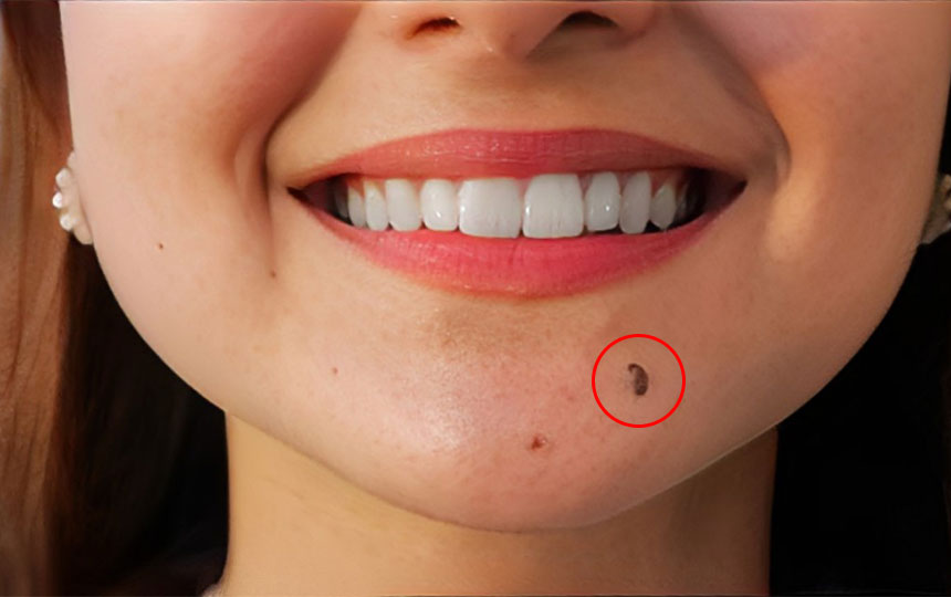 Which moles is for huge wealth?
