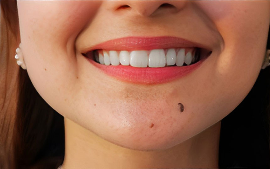 Whats the meaning of Mole on Chin