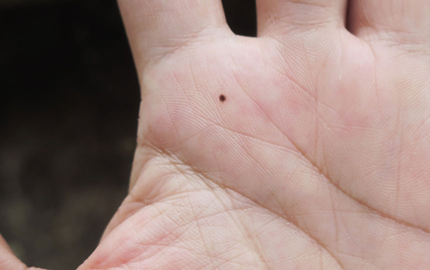What's the Meaning of moles on palm?