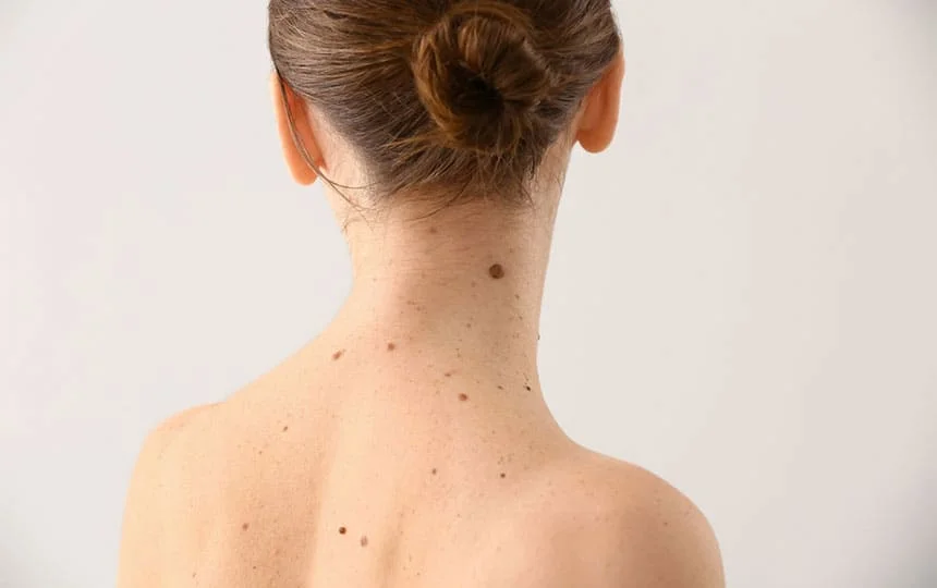 Find moles on neck meaning female